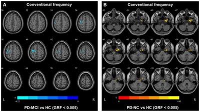 Abnormal Neural Activity in Different Frequency Bands in Parkinson’s Disease With Mild Cognitive Impairment